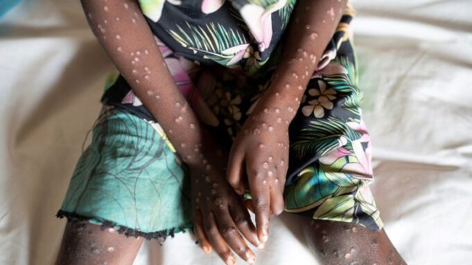 GHS intensifies surveillance as Mpox outbreak spreads across 15 African countries