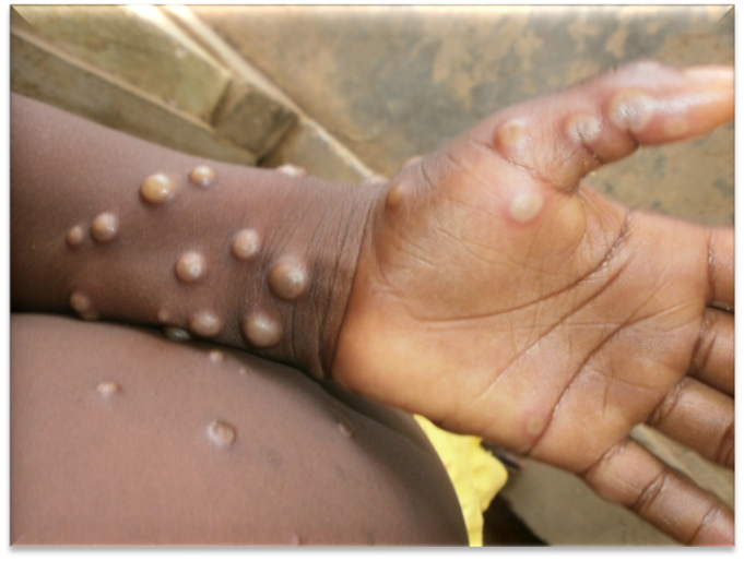 Mpox: GHS confirms second case