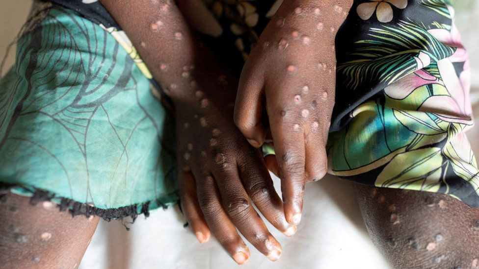 Ghana Confirms 735 Mpox Cases as Health Authorities Issue Renewed Alert